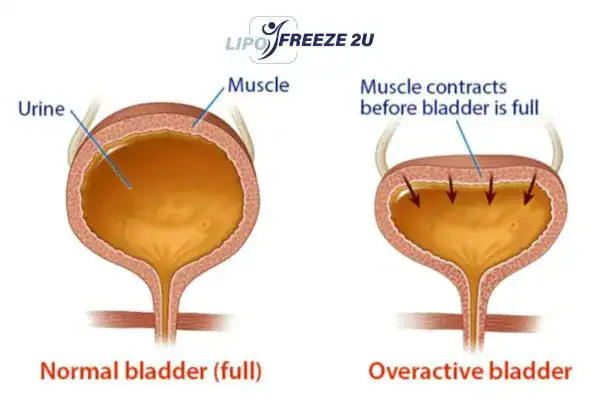 diagram of overactive bladder treatment Stirling