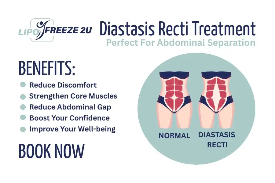How Long Will It Take to See Improvements in Diastasis Recti Stirling