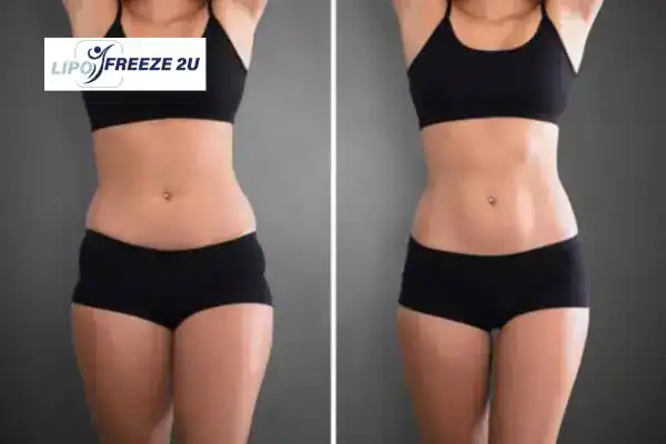 How Can LIPO FREEZE 2U Support Your Post-Pregnancy Body Recovery Stirling?