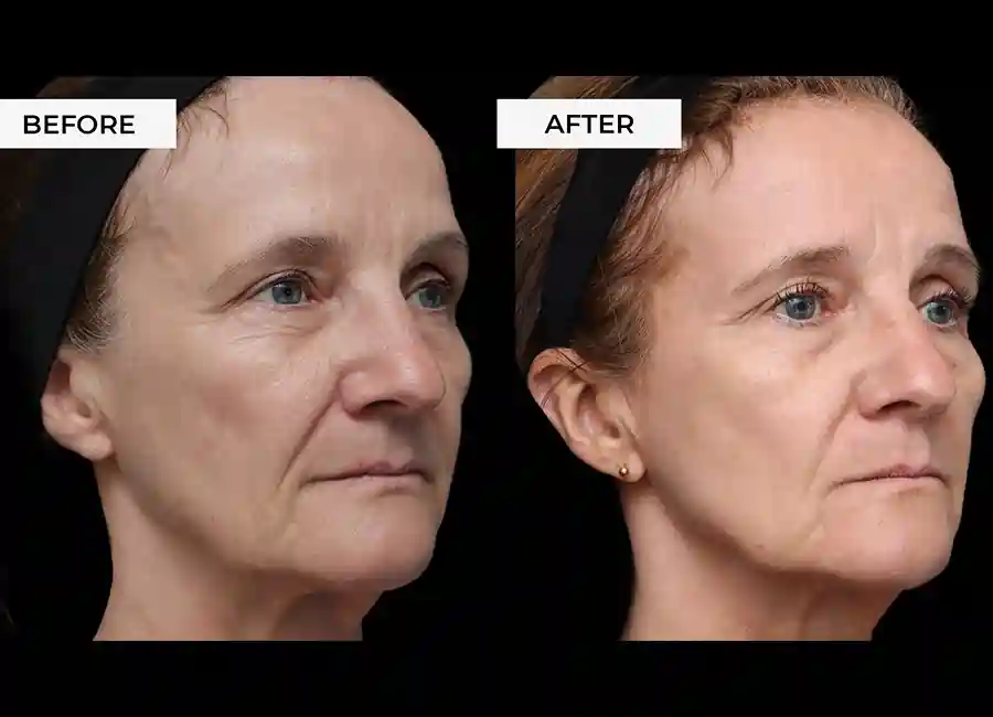 How Many RF Microneedling Sessions Will You Need to See a Difference Stirling?