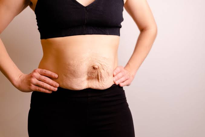 Is Surgery Really the Only Way to Repair Diastasis Recti Stirling?