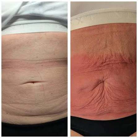 How Does RF Microneedling Improve Crepey, Thin and Uneven Skin Texture Stirling?