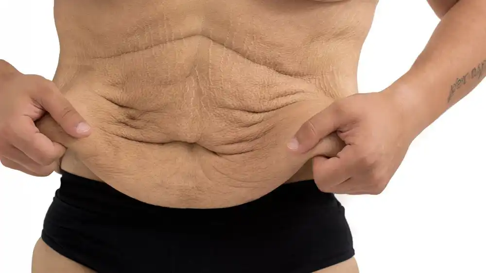 RF Microneedling for Loose Skin: How Can It Help Tighten and Reshape the Skin Stirling?